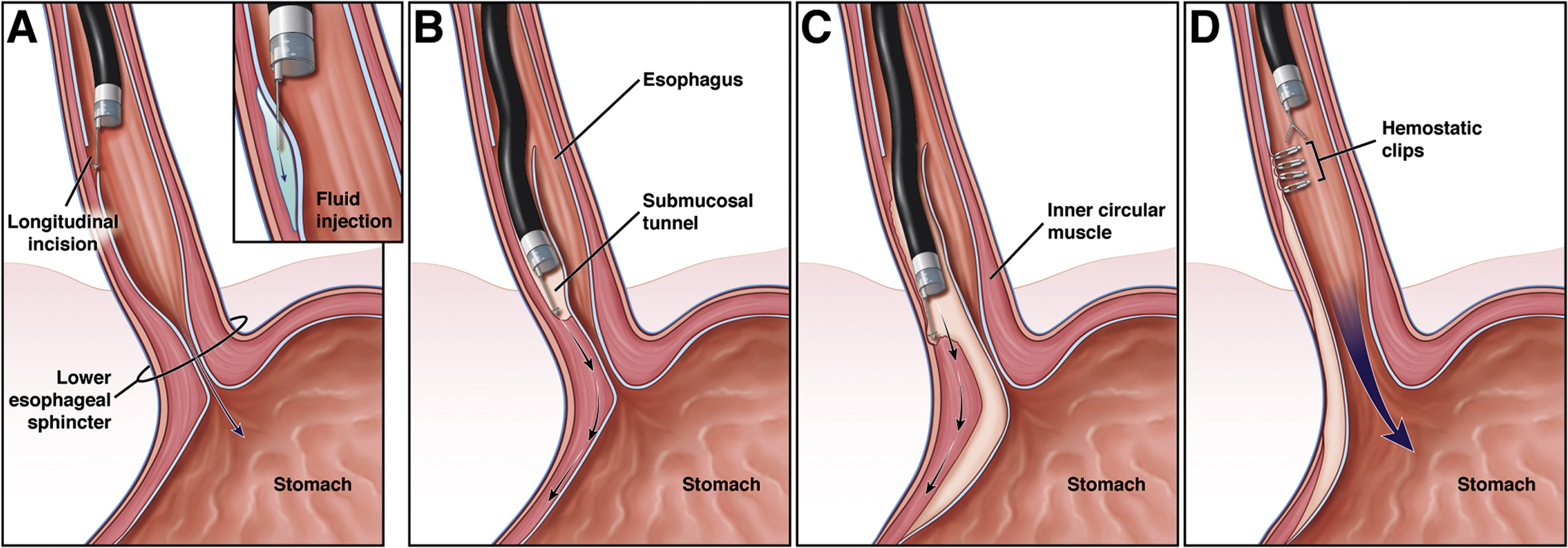 endoscopic-ear-surgery-unc-otolaryngology-head-and-neck-surgery